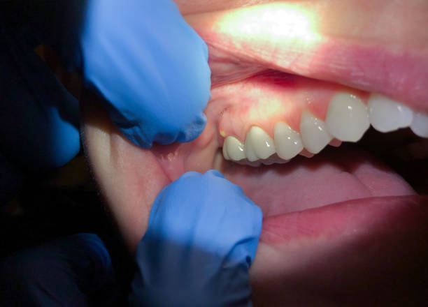 Best Emergency Root Canal Treatment in Bluffton, OH