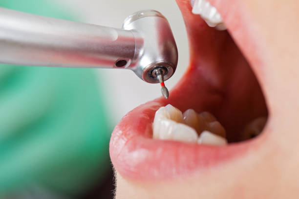 Best Emergency Dentist for Knocked-Out Tooth in Bluffton, OH